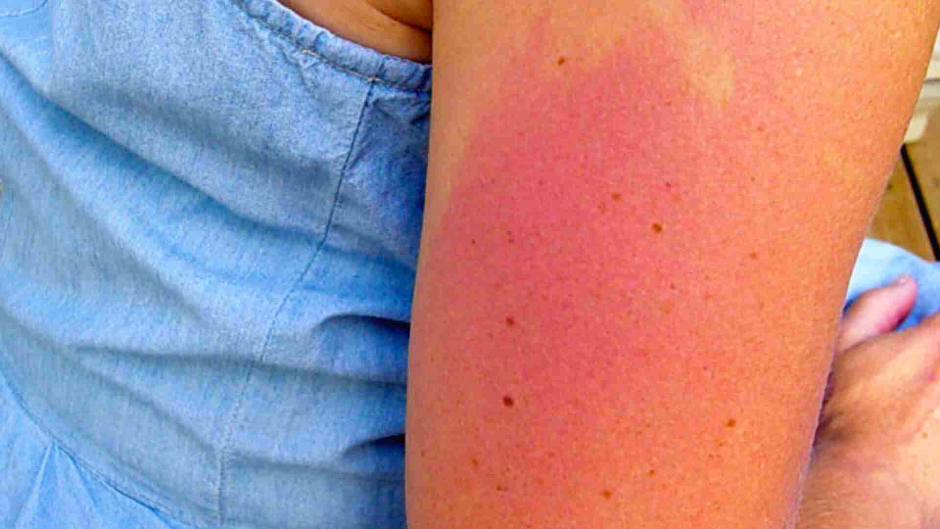 What Does Sun Allergy Rash Look Like See These Pictures