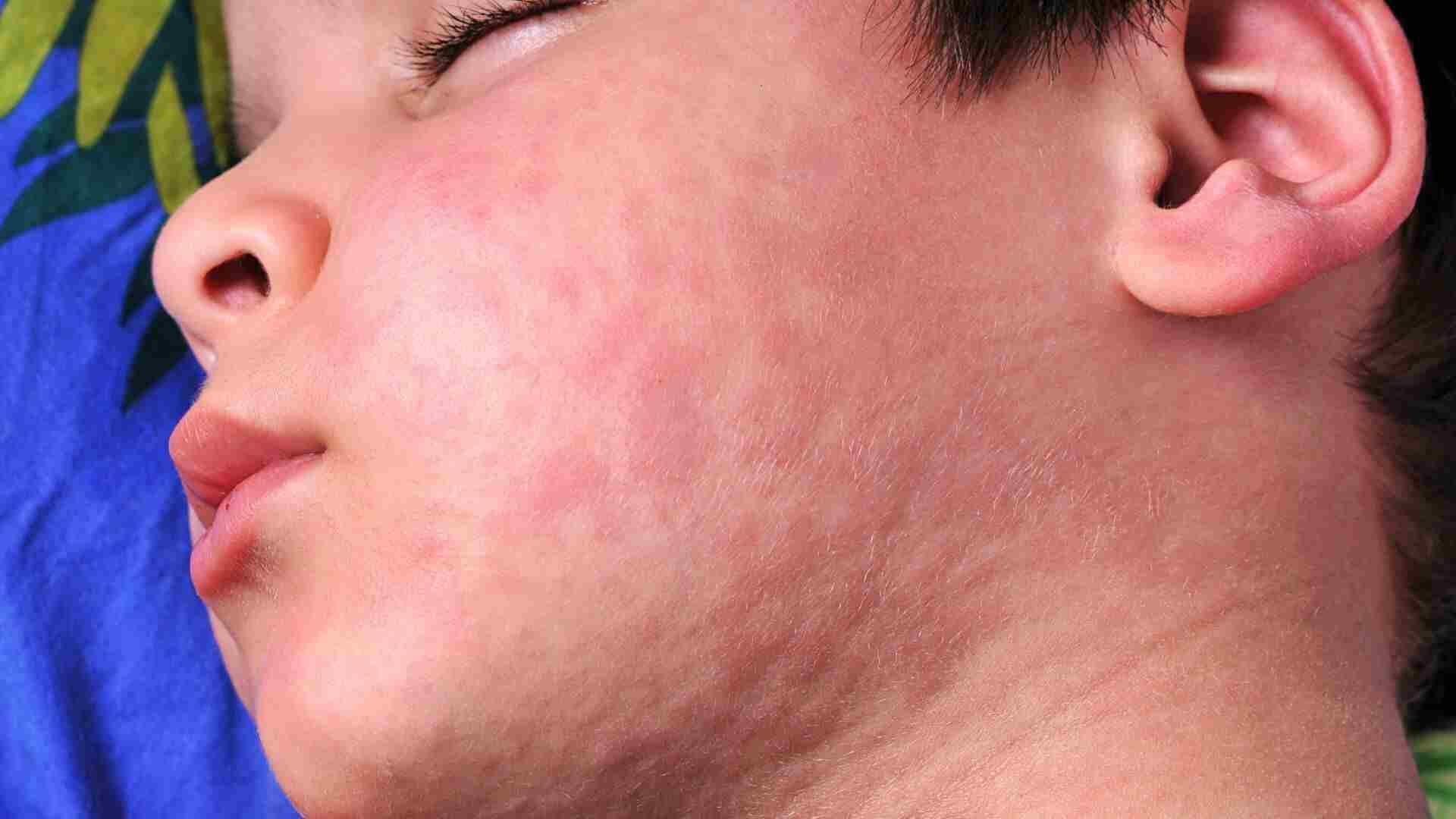 What Does Sun Allergy Rash Look Like? See These Pictures