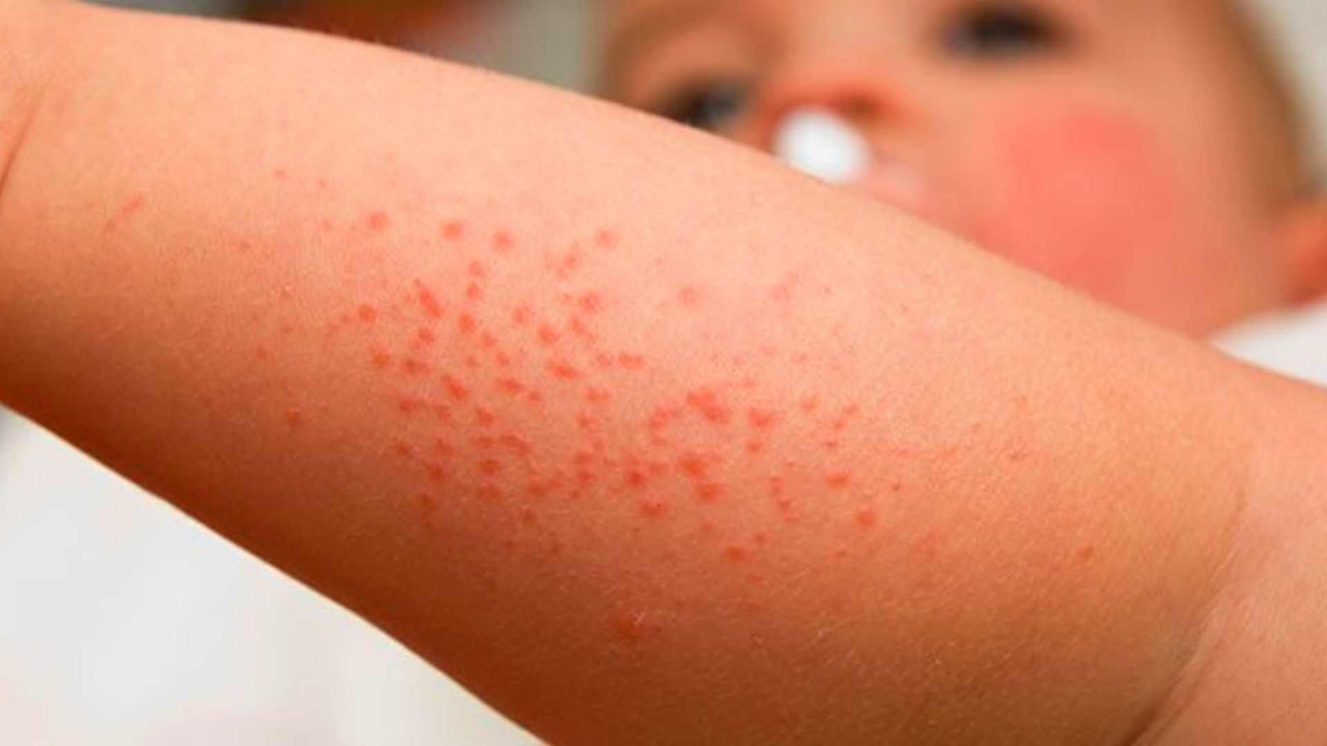 What Does Sun Allergy Rash Look Like? See These Pictures